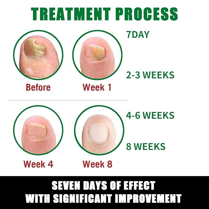 Nail Fungus Treatment | Ginger & Herbal Blend